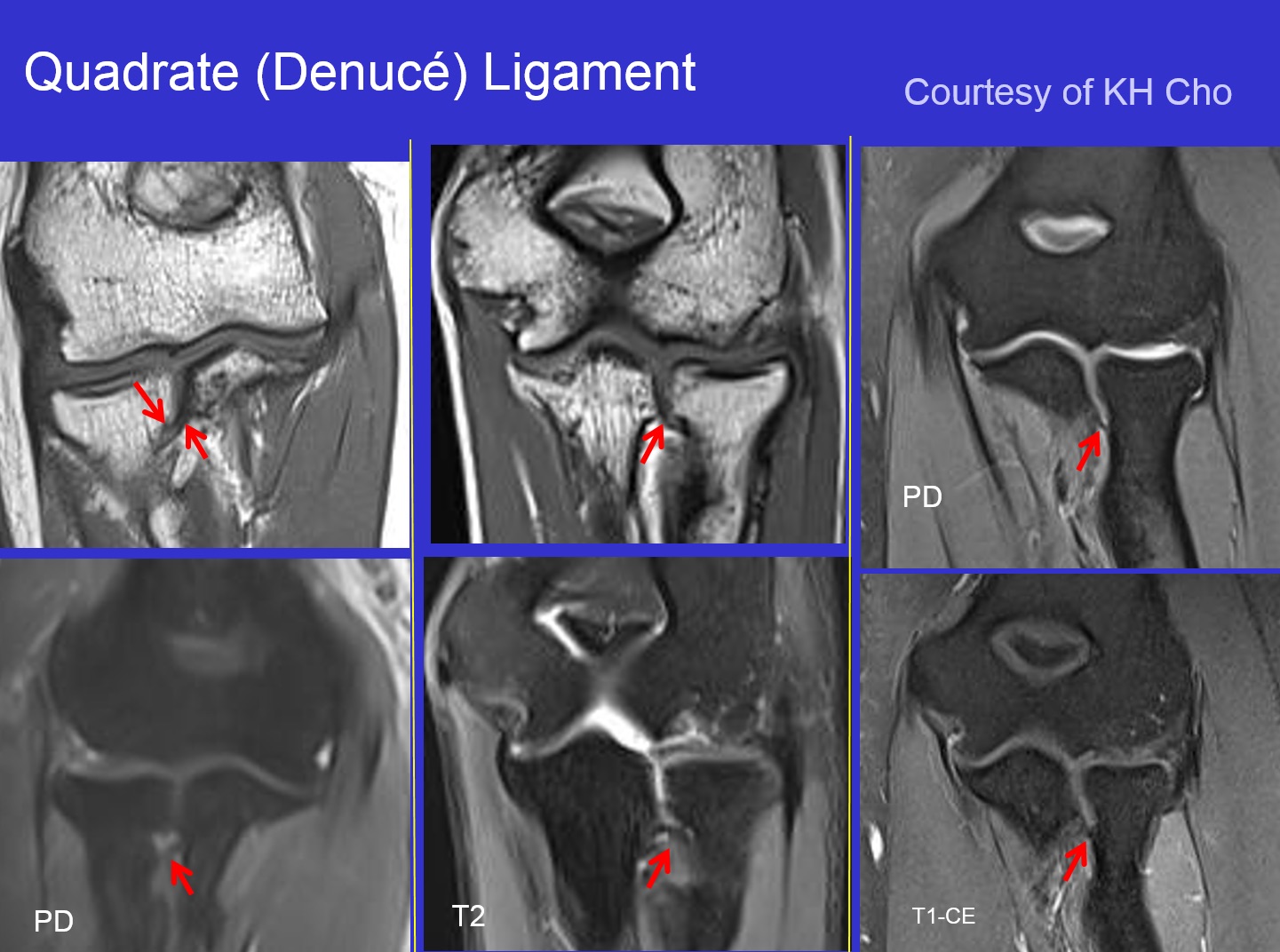 Figure 2 for case Quadrate ligament of elbow ( RID2051 )